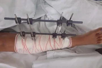 Criança é atropelada em Valparaíso ao atravessar a rua em frente a uma escola em 25; motociclista foge sem prestar socorro.